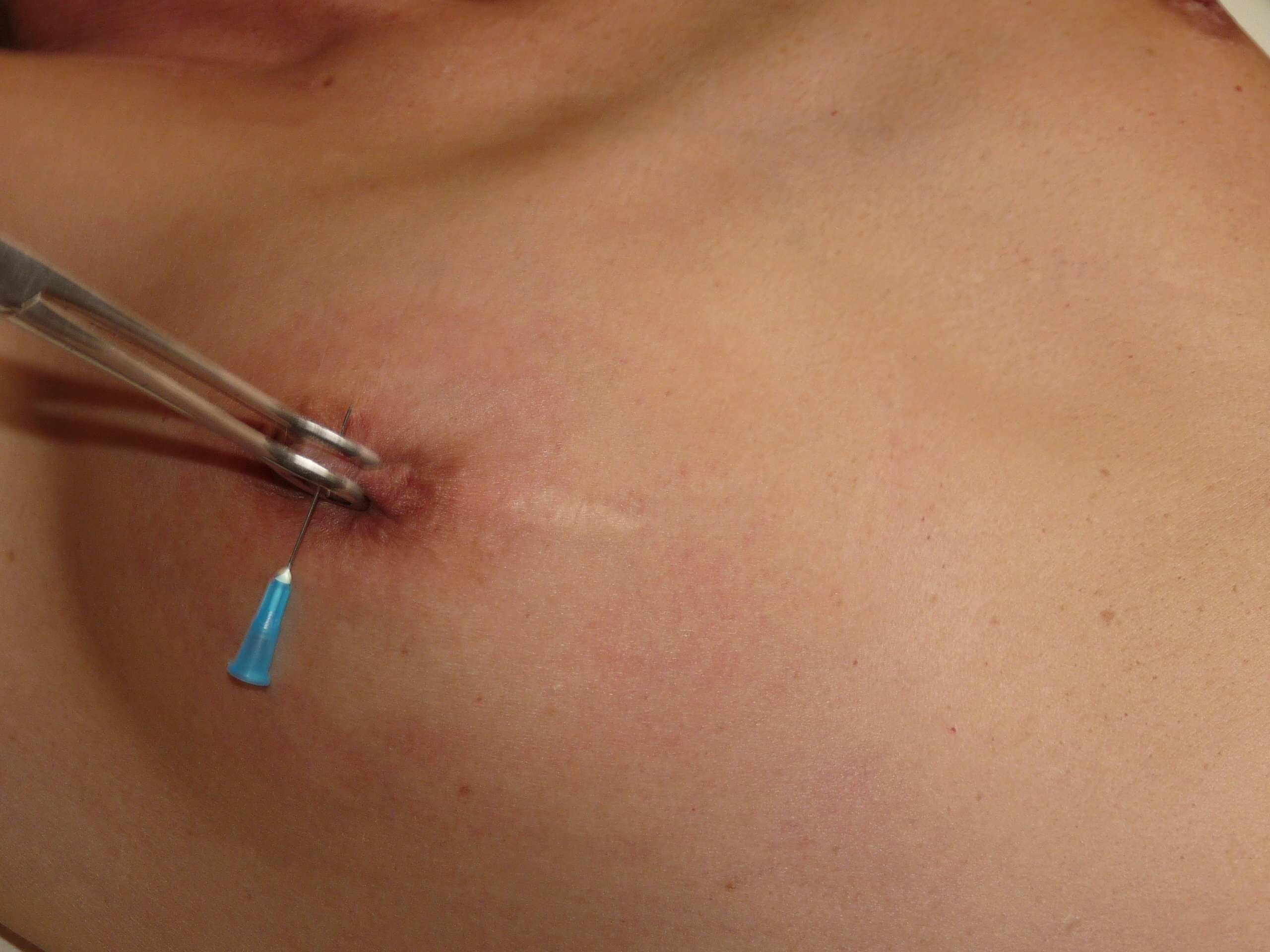 Amateur Needle Pain.